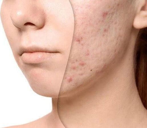 Κρέμα Προσώπου Herbstore Against Acne Ημέρας για Ενυδάτωση & Ακμή 50ml